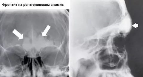 На фото рентгеновской пленки  стрелками указаны участки поражения. Это и есть фронтит.