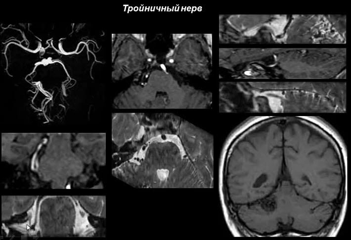 Исследование тройничного нерва при помощи МРТ