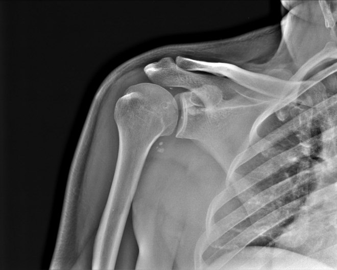 Снимок плечевого сустава на КТ