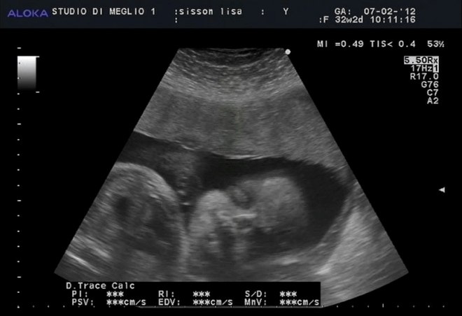 Снимок УЗИ ребенка на 38 неделе беременности