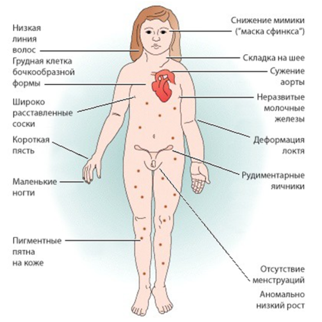Признаки синдрома Шерешевского-Тернера