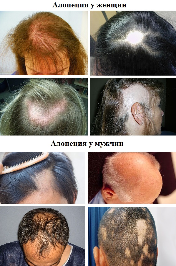 Как остановить выпадение волос на голове и увеличить их густоту