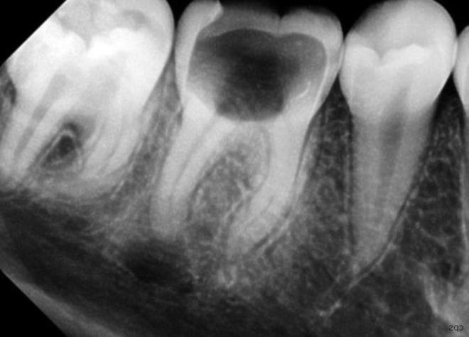 Рентген больного зуба