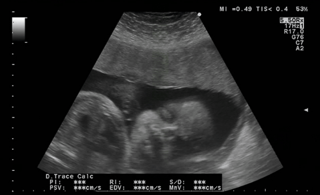 Снимок УЗИ на 36 неделе беременности