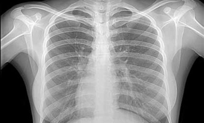 Рентгенограмма легких