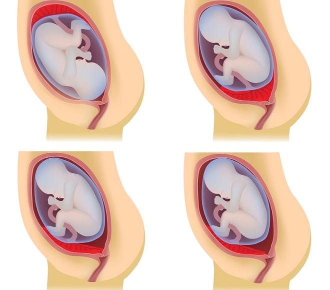 Опущение плаценты у беременной