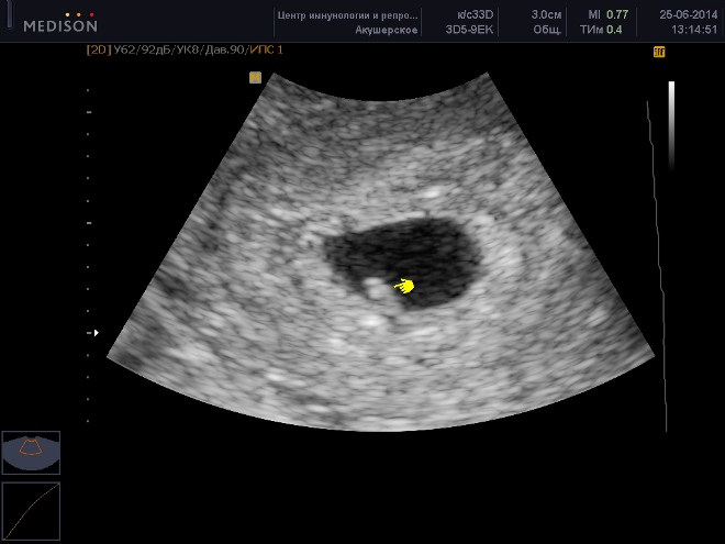 Снимок первого УЗИ при беременности