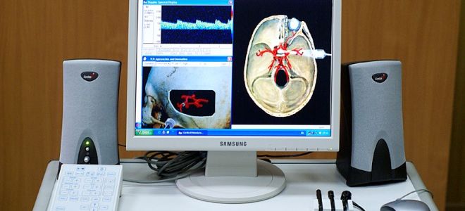 Что такое транскраниальная допплерография сосудов головного мозга и как ее делают