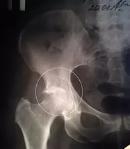 Рентгенография тазобедренного сустава: для чего проводится