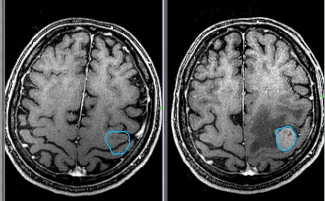 Опухоль головного мозга на снимке МРТ
