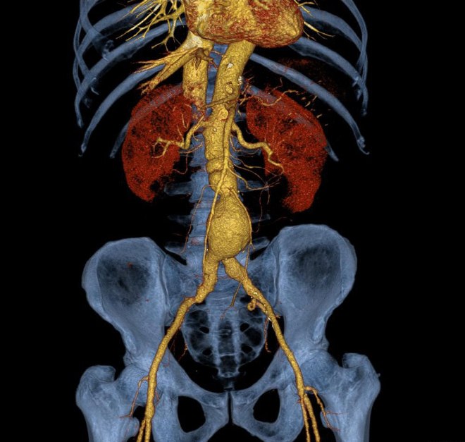 Снимок КТ брюшной аорты и ее ветвей с контрастом