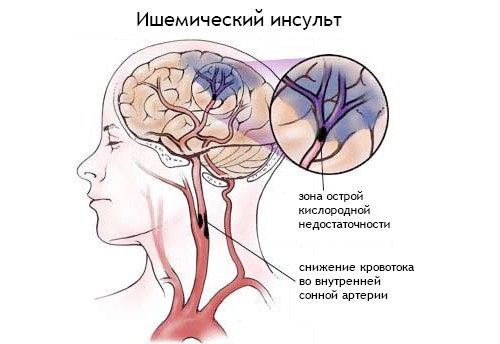 Ишемический инсульт головного мозга: симптомы, лечение и восстановление