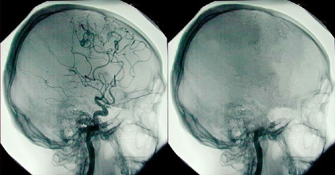 Снимок церебральной ангиографии