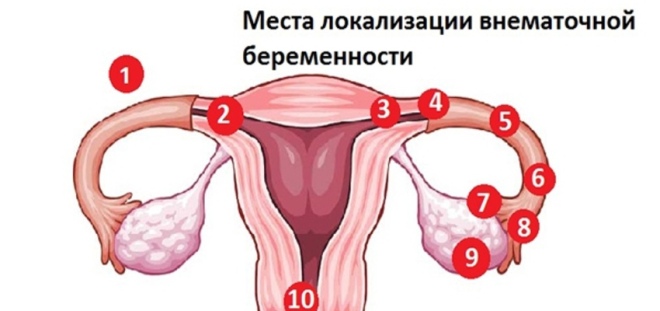 Места локализации внематочной беременности
