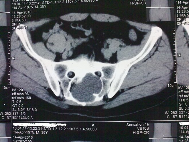 Снимок КТ органов малого таза