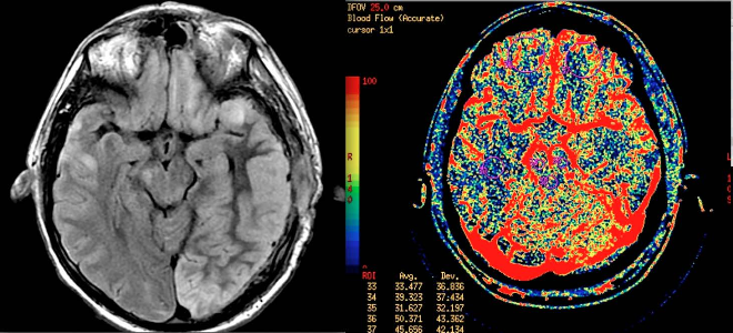 Снимок КТ перфузии головного мозга с контрастом