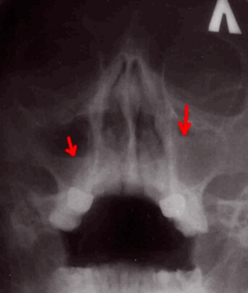 рентген снимок двустороннего верхнечелюстного синусита.