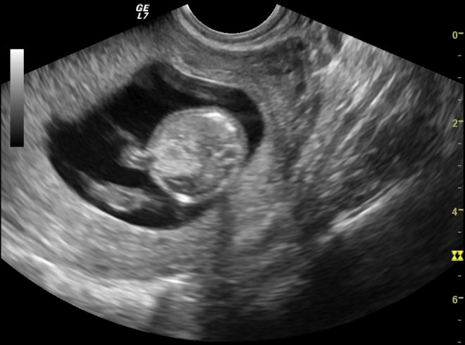 Снимок УЗИ в первом триместре беременности