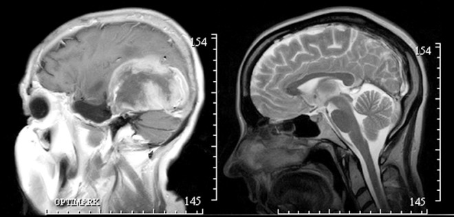 Снимок МРТ головного мозга