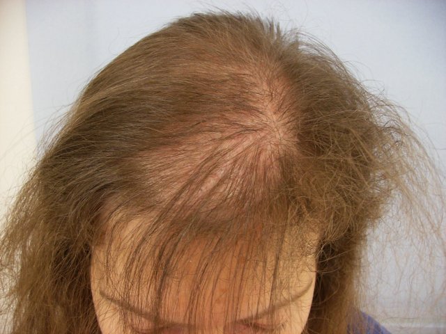 Сколько длится выпадение волос после стресса — Психические заболевания