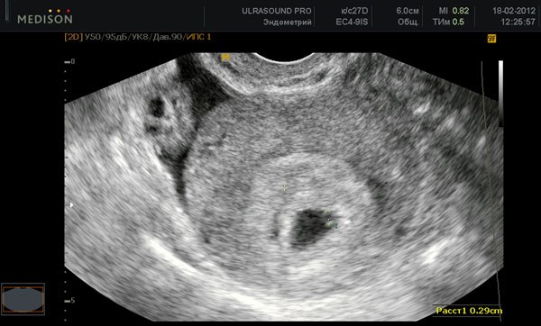 Снимок УЗИ на 4 неделе беременности