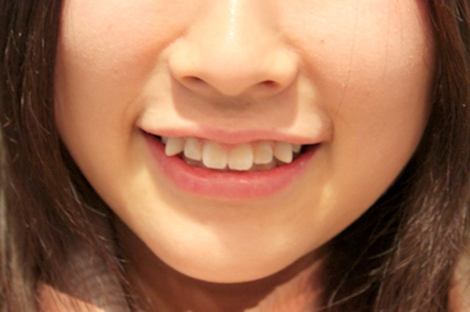 Искривленные зубы