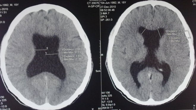 Снимок КТ головного мозга