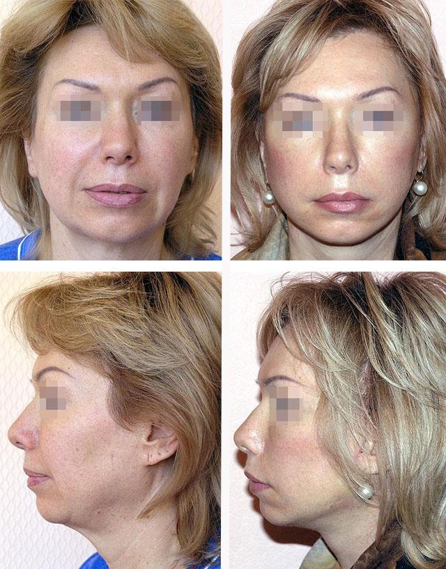 Как делают подтяжку лица хирургическим путем фото до и после