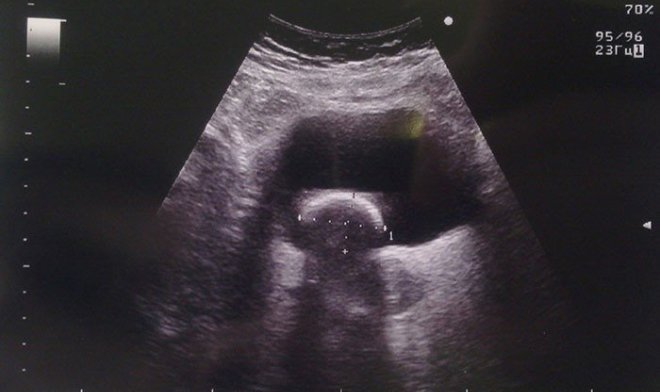 Снимок УЗИ мочевого пузыря
