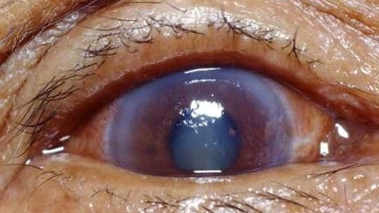 Глаукома: причины, симптомы, лечение и профилактика