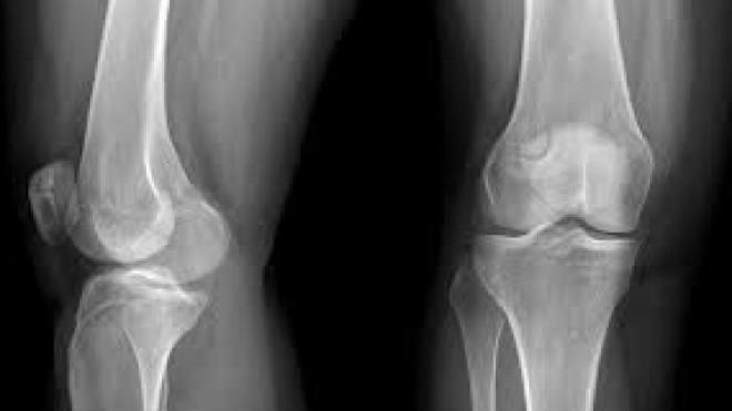 Рентгеновский снимок коленного сустава