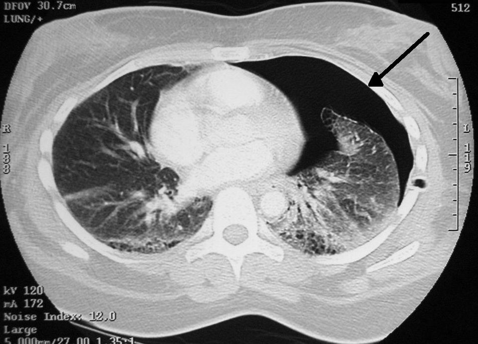 Пневмоторакс: особенности патогенетического характера на рентгене
