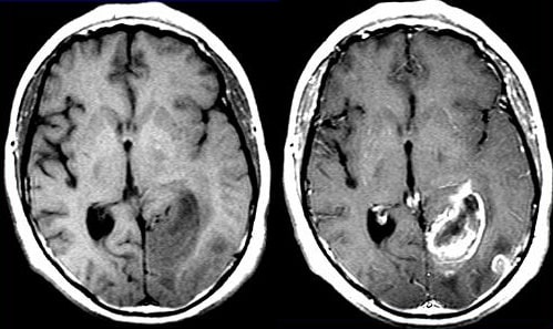 МРТ при опухолях головного мозга: классификации, снимки