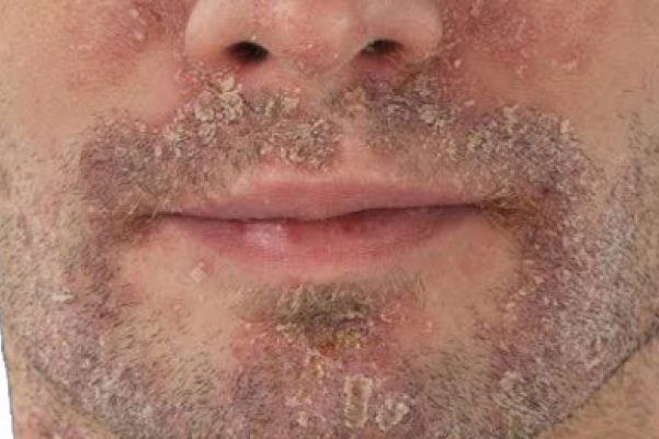 Как избавиться от шелушения кожи на лице