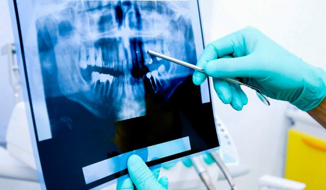 Расшифровка рентгеновского снимка зубов