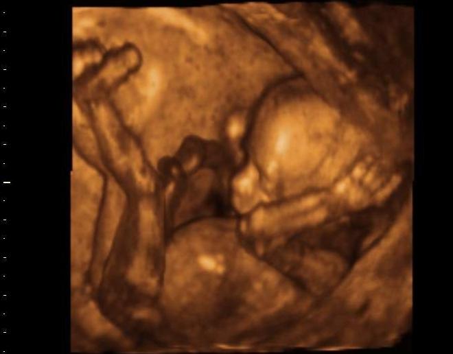 Снимок 3Д УЗИ на 16 неделе беременности