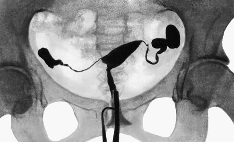 Рентген маточных труб: назначение и особенности проведения процедуры