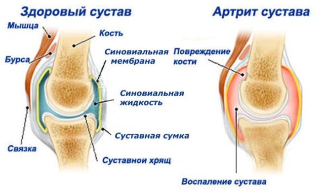 Признаки артрита суставов
