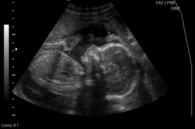Снимок УЗИ на 23 неделе беременности