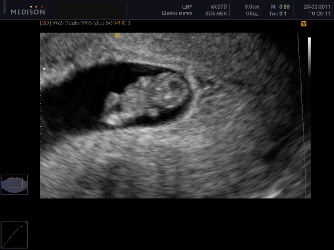 Снимок УЗИ на 1 триместре беременности