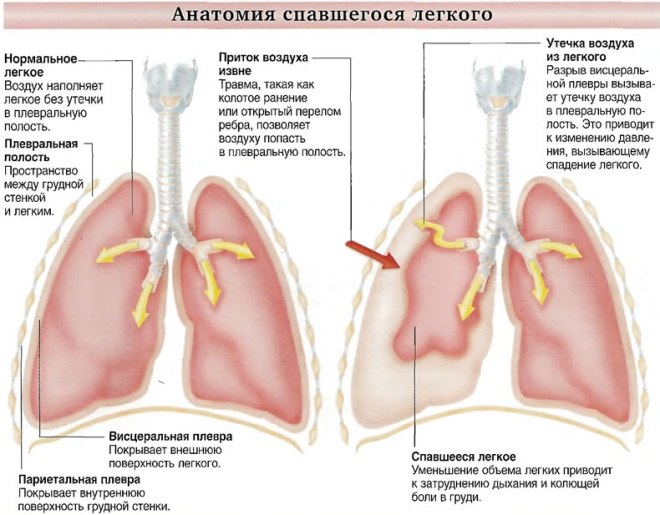 Анатомия пневмоторакса