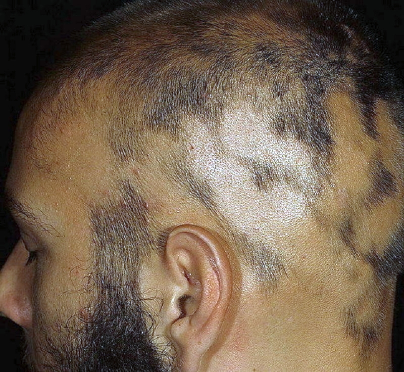 Гормоны влияющие на выпадение волос при гормональном сбое