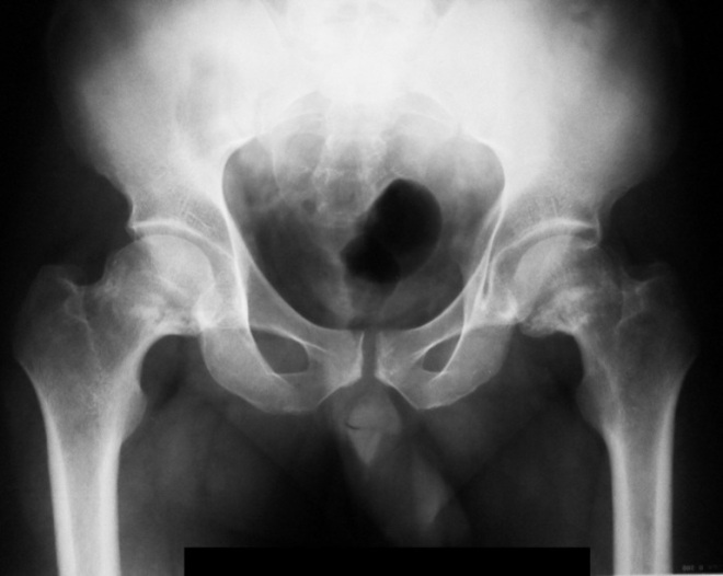 Рентгеновский снимок тазобедренных суставов