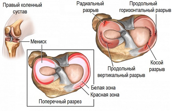 Рентген коленного сустава: что показывает диагностика