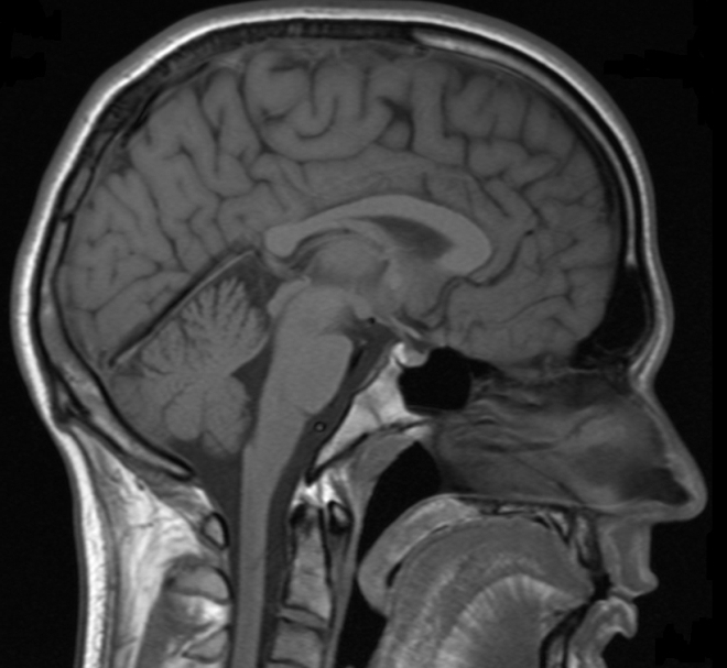 МРТ головного мозга беременной