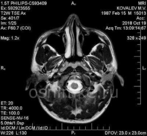 МРТ головного мозга снимок здорового человека