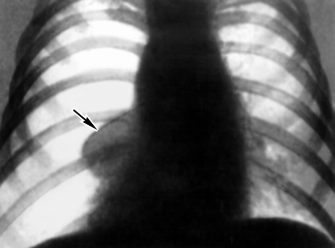Рентгенограмма при пневмотораксе