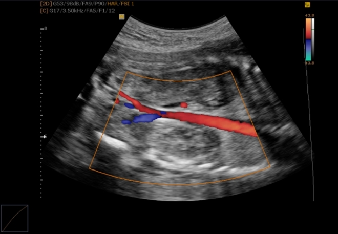 Результат триплексного сканирования брахиоцефальных артерий