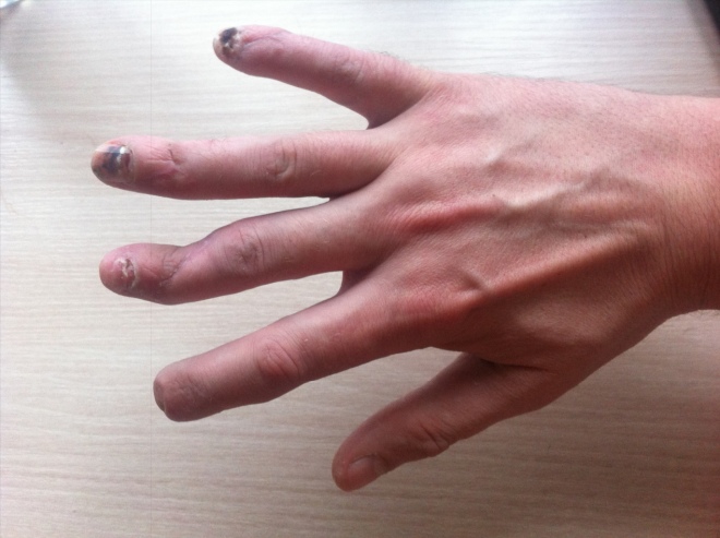 Перелом пальца руки