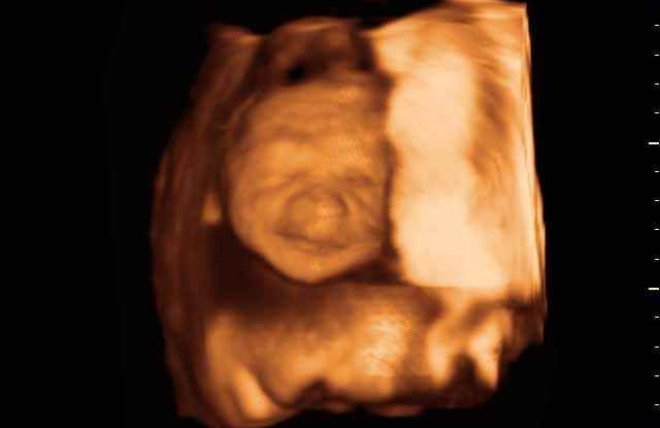 Снимок 3Д УЗИ на 26 неделе беременности